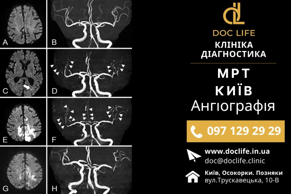 Застосування МР-ангіографії перед склеротерапією вен Застосування МР-ангіографії перед склеротерапією вен