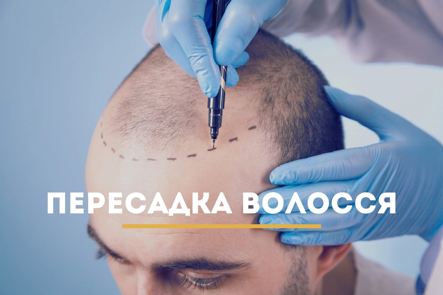 Алопеція: що варто знати про випадіння волосся та сучасні методи лікування Новини Здоров'я Алопеція Алопеція: що варто знати про випадіння волосся та сучасні методи лікування Новини Здоров'я Алопеція