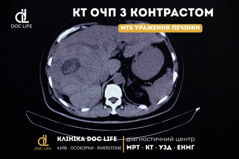 Метастази в печінці: всі методи діагностики, клінічні приклади та вибір найточнішого обстеження