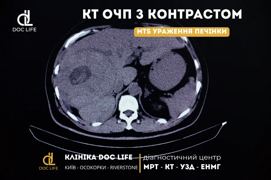 Метастази в печінці: всі методи діагностики, клінічні приклади та вибір найточнішого обстеження